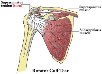 Motion of the Shoulder Painful