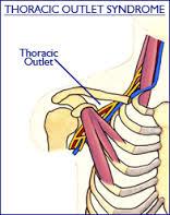 stenosis Carpal tunnel syndrome Osteopathic