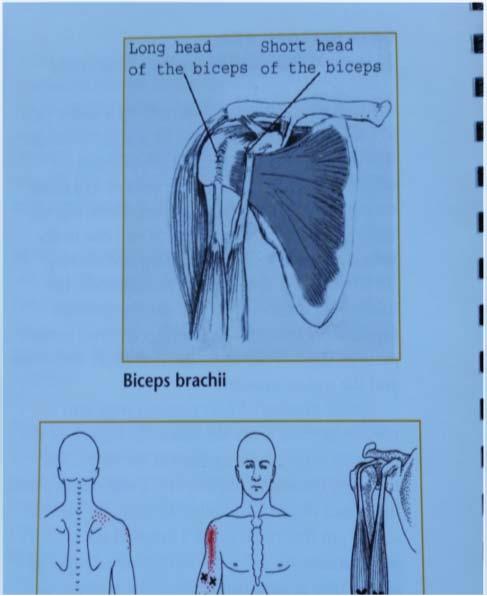 Counterstrain for long head of the biceps Counterstrain for long head of the biceps Location of the tender point: over the tendon of the long head of the biceps muscle, in the bicipital groove