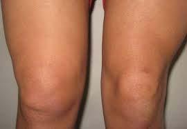 Causes of Knee Effusion Overuse Internal
