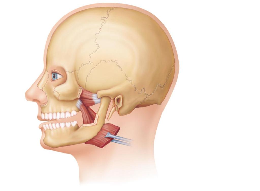 Muscles of Mastication Lateral pterygoid Medial