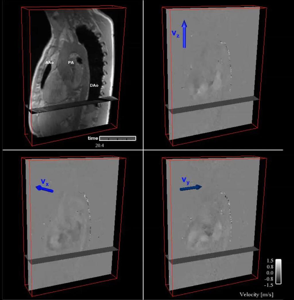 4D Flow MRI Methods 4D (3D volume + time); flow (3-dir.