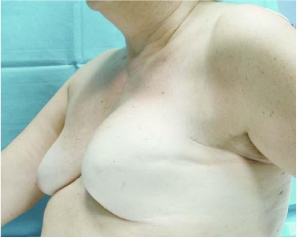 Breast Contour Deformities after Breast Reconstruction Journal of Advanced Plastic Surgery Research, 2015, Vol. 1 27 a: b: c: d: Figure 3a: A 63 y.o. woman in which breast deformities after oncologic treatments are evident.