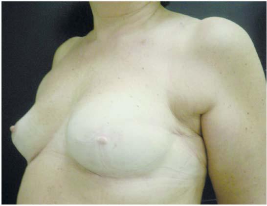 volume [14-16]. Furthermore dermoadipose grafts could be used. They could be collected from controlateral breast but also from abdominal tissue during a simultaneous abdominoplasty.