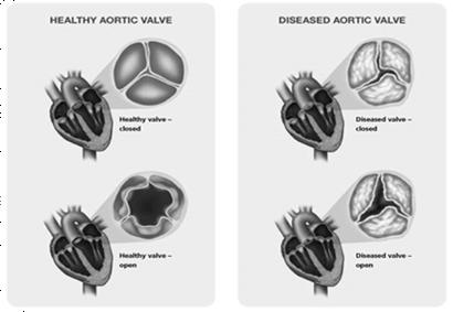 TAVR for Aortic Stenosis Age-related calcific aortic stenosis Symptoms of Aortic Stenosis Shortness of breath Angina Fatigue Syncope or Presyncope Other Rapid or irregular heartbeat Palpitations