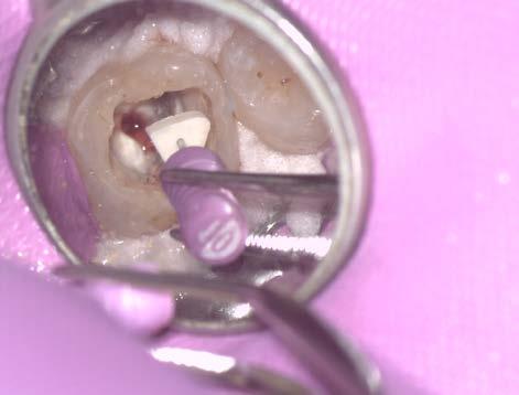 08 Orifice Opener of the MANI system Once the patency of the root canals had been confirmed with the MANI D-Finder, a straight-line access was created with