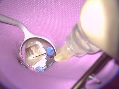 Afterwards, the root canals were prepared with the system MANI Silk Complex (mesial #25, 0.04/19 mm, distal #25, 0.