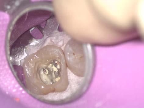 Subsequently, the root canals were obturated in the one-point technique and the lateral condensation technique