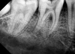 Alexanderson. De Moor et al.; have classified RE evaluated from extracted teeth into three types: Type I refer to straight roots or canal.