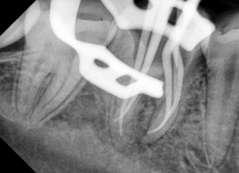 Presence of additional root was confirmed by mesially angled radiography. Local anesthesia was administered and the tooth was isolated under rubber dam.