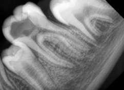 (Figure 5, 6) is final radiography of root canal treatment. Cavit was used as a temporary filling material. Patient was referred to restorative department.