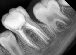 Figure 3 case 2 A diagnostic radiograph was taken which suggested deep caries with pulpal