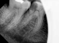 Pulp vitality testing of the involved teeth with cold (DENRONIC, Aero nova GmbH & Co.