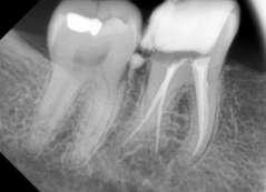 (Figure 2-4) Figure 1 case 4 Figure 3 case 4 Figure 4 case 4 Case report 5: A 34 years old female patient referred to Department of Endodontics with a chief