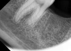 Local anesthesia was administered and the tooth was isolated under rubber dam. Access preparation was done.  (Figure 2-4) Figure 3 case 4 Figure 1 case 5 406
