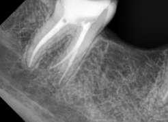 There was no mobility and periodontal status was within normal limits.