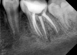 Presence of additional root was confirmed by object localization radiographic