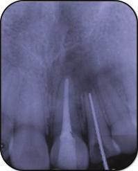 discoloration in left maxillary lateral incisor.