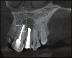 (e) Coronal plane CBCT image showing size of periapical lesion