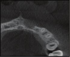 (f) Coronal plane CBCT image showing size of periapical lesion;