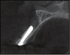 (j) Three-dimensional CBCT image of periapical lesion  (k) Sagittal