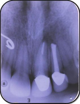 9 mm. (h) Sagittal plane CBCT image showing decrease in size of periapical lesion at six