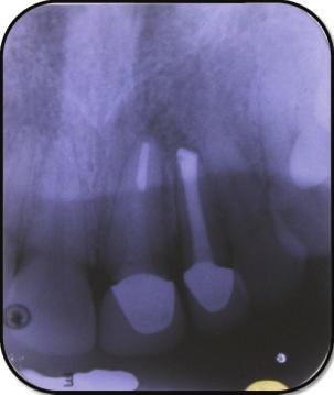 (i) Axial plane CBCT image showing decrease in size of periapical lesion at six  (j)