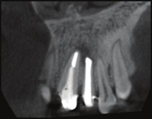 showing status of MTA obturation at six  (l) Axial plane CBCT image showing status of