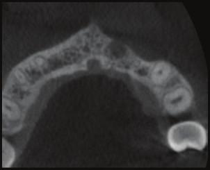 When endodontic treatment is done properly, healing of the periapical lesion occurs with