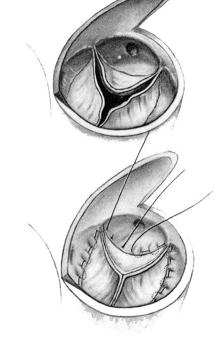 Techniques for Aortic Annuloplasty