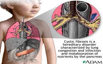 Cystic Fibrosis A genetic disorder that causes thick mucus to build up in a person s lungs and intestinesmaking it hard to breathe.