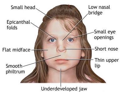 Clinical Manifestations in Thalassaemias: (Important) Pallor. Jaundice (There is No jaundice in IDA).