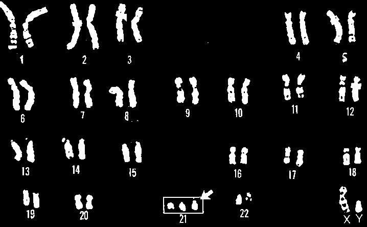III. What genetic disorder is present in this karyotype? Can we tell if a baby has a genetic disease? A.