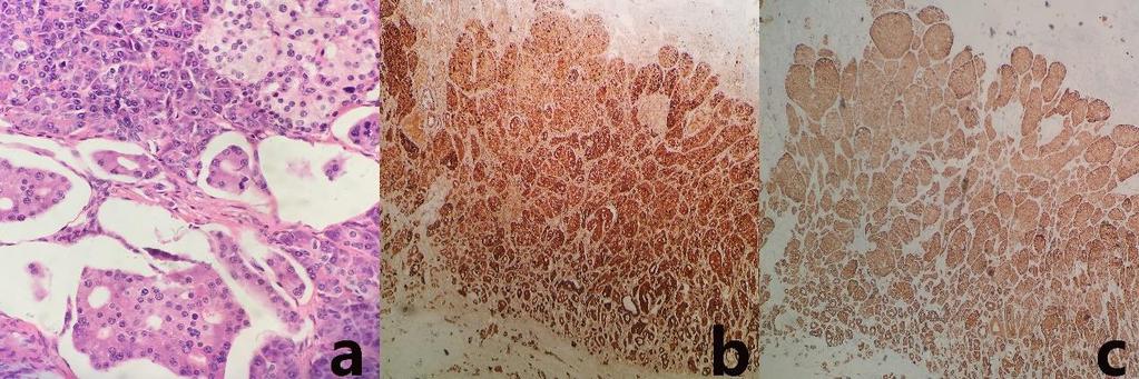 figure 4. a. Histological examination showed the distinctive histologic features of an endocrine tumor, i.e., uniform, large polygonal-to-columnar cells with abundant granular cytoplasm.
