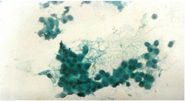 X 10) Figure 2: Smear from malignant lesion showing increased