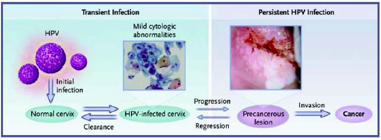 Cervical Cancer is Caused by HPV HPV acquired through sexual and genital skin-to-skin contact Prevalence peaks within few years of median sexual debut age (17 yo) >90%