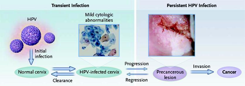 Natural History of HPV