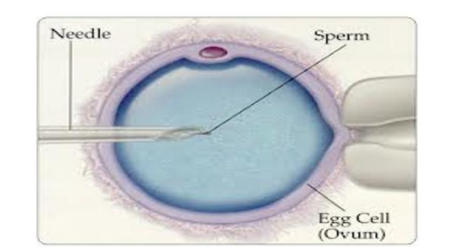 IVF enables fertilisation, outside the body, in a culture dish IVF overcomes the problem of infertility caused by a blockage of the oviducts It takes place in the following 6 stages 1.