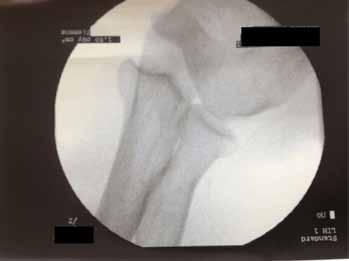 of the left elbow without fracture.