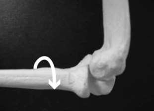 Posterolateral Rotatory Instability Most common pattern Described by O Driscoll 1991
