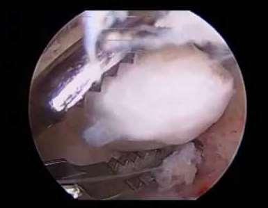 Diagnosis Can be used to verify Anteromedial portal Elbow at 60 degrees with valgus stress gapping