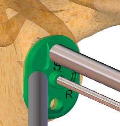 osteoporotic 3 5 Drilling stabilization holes: Place or replace the K-wire-guide template for the symmetrical glenoid