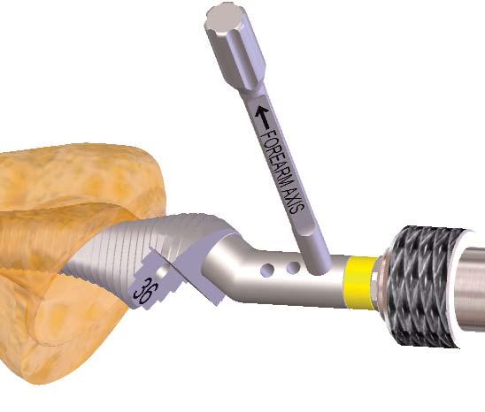 40 mm; Ø16 mm --> Stem with an epiphysis of Ø40 mm; Connect the rasp to the T handle Screw the retroversion rod onto the rasp Impact the rasp until it is flush with the height of the resected bone