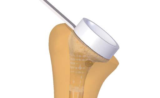 HEMI-PROSTHESIS ADAPTOR TECH 1 Humeral cup removal: Remove the cup by