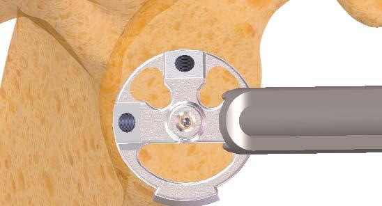 Humphrey CS, Norris TR Optimizing glenosphere position and fixation in reverse shoulder arthroplasty, Part One: the twelve-mm rule J Shoulder Elbow Surg 008;17:589-94 Glenoid