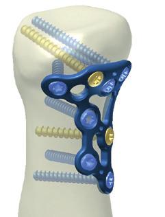 xx) or with cortical screws (A-5400.xx) wherever the fracture pattern requires it. Place at least three screws in the shaft and the head part of the plate in order to achieve a sufficient stability.