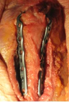 placement of at least two screws in the proximal fragment. The two plates should be placed whenever possible as shown in the figure.