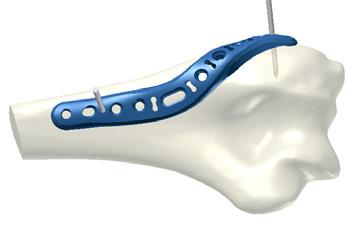 32 Elbow System 2.0, 2.8 In the case of a 180 configuration, place a lateral plate additionally to the medial plate.