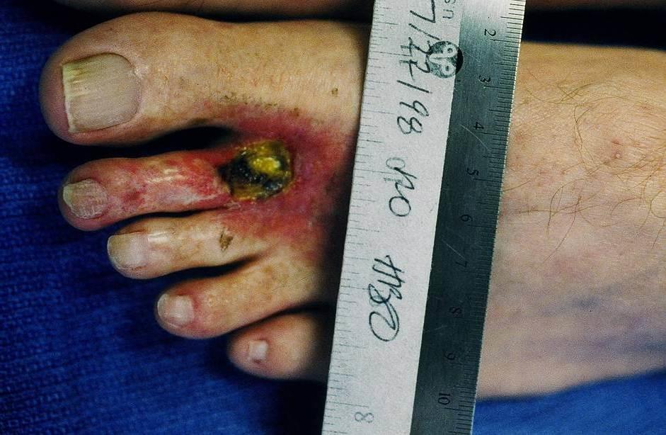 Radiation to Toe for Wart as a child,