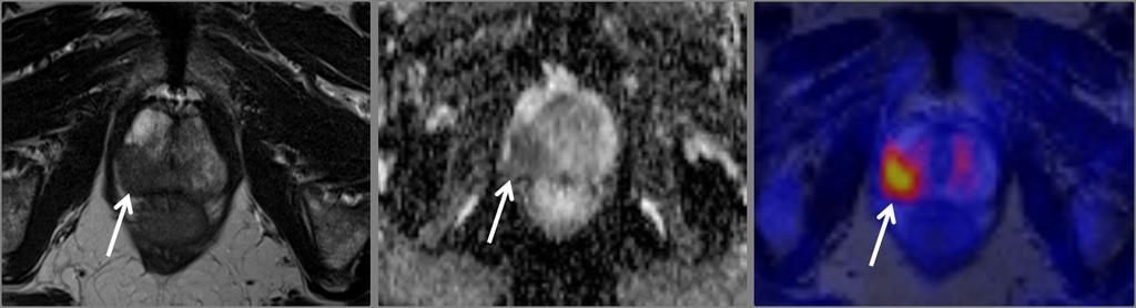 [18F] choline PET/MR imaging was performed after PET/CT. The images illustrate the combined findings of anatomical sequences together with diffusion-weighted imaging and PET imaging. Figure 1.